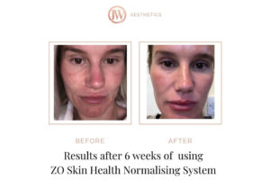 ZO Skin Health Results: Before & After