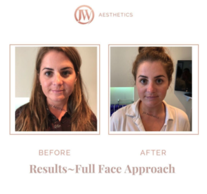 Full face shape modification before & after